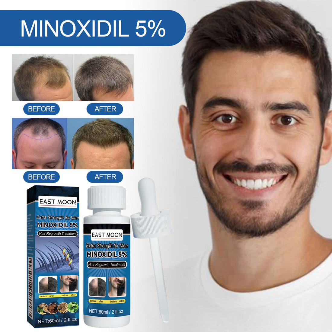 EAST MOON 5% Minoxidil Topical Hair Solution — promotional comparison illustration